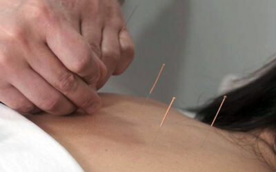 La Acupuntura como remedio para la tendinitis del hombro