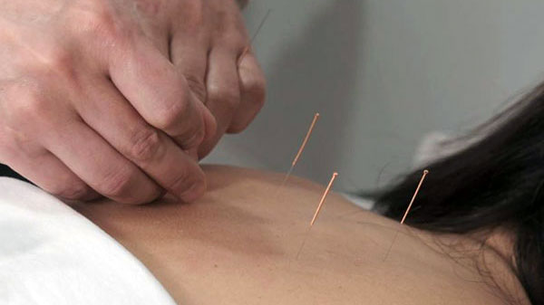 Acupuntura-Tendinitis-hombro La Acupuntura como remedio para la tendinitis del hombro