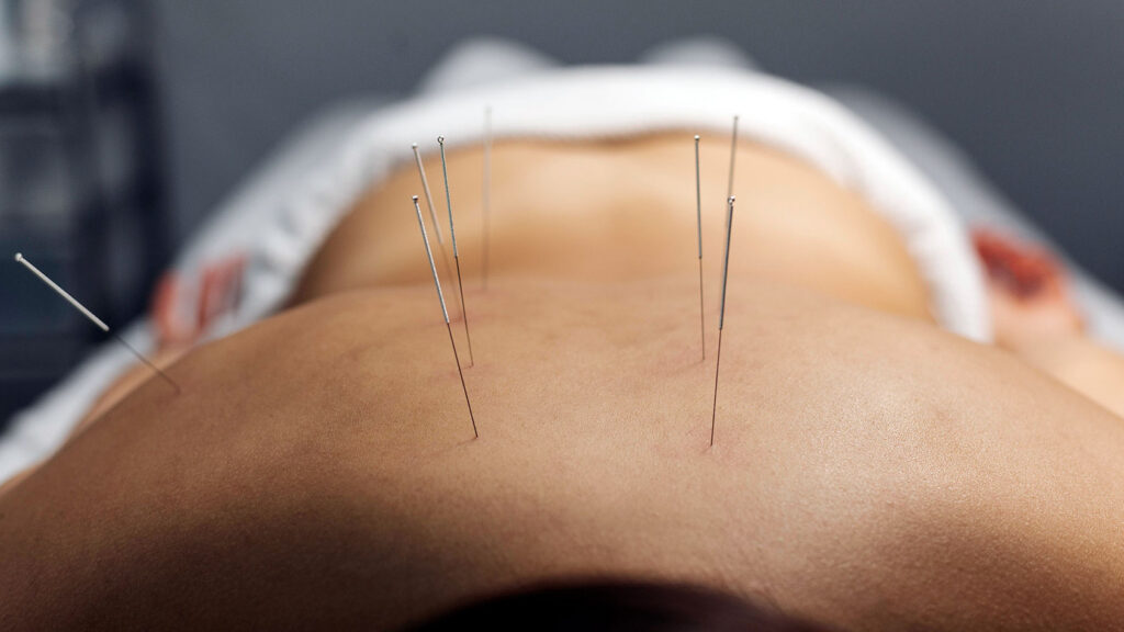 La Acupuntura como remedio para la tendinitis del hombro