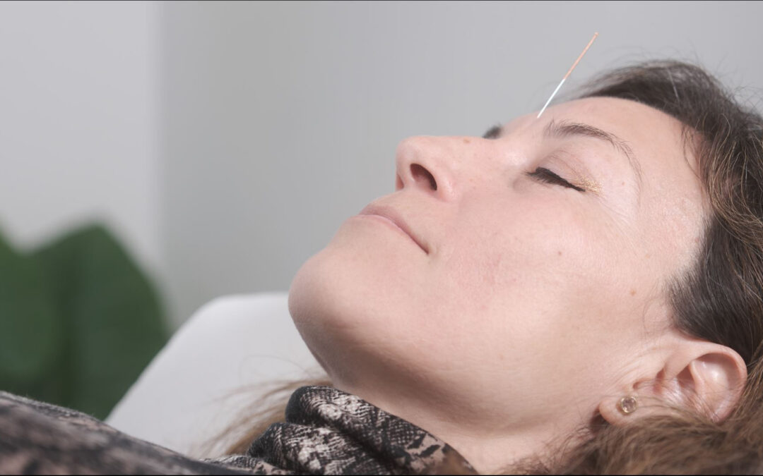 Tratamiento de la parálisis facial con acupuntura