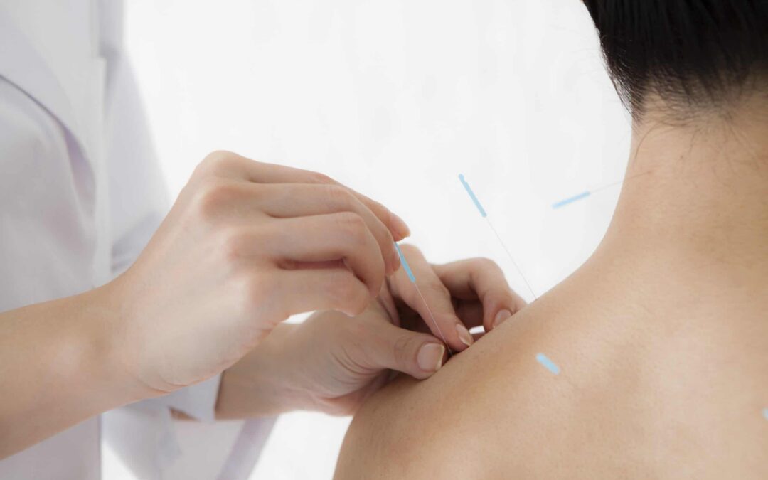 Un caso de tratamiento de tendinitis del hombro con acupuntura